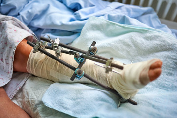Broken ankle - orthopedics
Close Up of broken angle with wire support