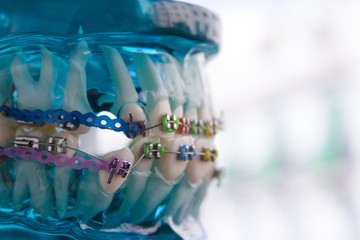 Classic dental metal orthodontics with colored hooks