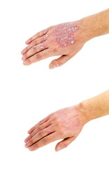 Psoriasis vulgaris on the hand, before and after treatment, isolated on white background. Closeup.