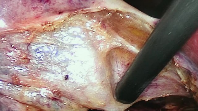 Abdominal cavity inside during operation laparoscopy. Professional medical equipment in operating room. Work of surgeon doctor.
