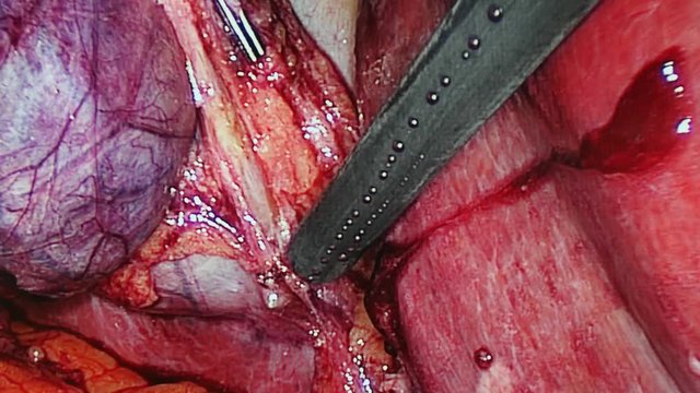 Abdominal cavity inside during operation laparoscopy. Professional medical equipment in operating room. Work of surgeon doctor.