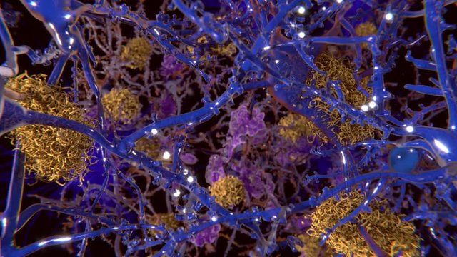 Alzheimer Krankheit: Im Vordergrund: gesunde Neuronen. Die gelbe Strukturen sind Amyloid-Plaques, die Neuronen schädigen. Violett: Microglia-Zellen, die kranke Neuronen phagozytieren und degradieren.