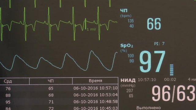 Cardiogram of rhythm of heart and pulse image on monitor during operation. Professional work of surgeon doctor.