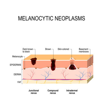 Melanocytic Nevus