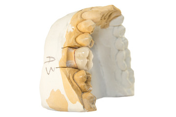 cermet tooth crown on a plaster model of the jaws of teeth at the stage of manufacturing isolate on a white background close-up