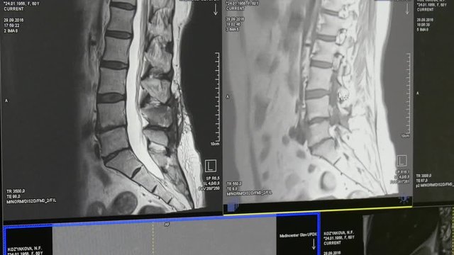 Spinal cord and spinal column tomography on MRI scan. Diagnosis of a person in the clinic. Professional Medical Equipment.