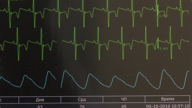 Cardiogram of rhythm of heart and pulse image on monitor during operation. Professional work of surgeon doctor.