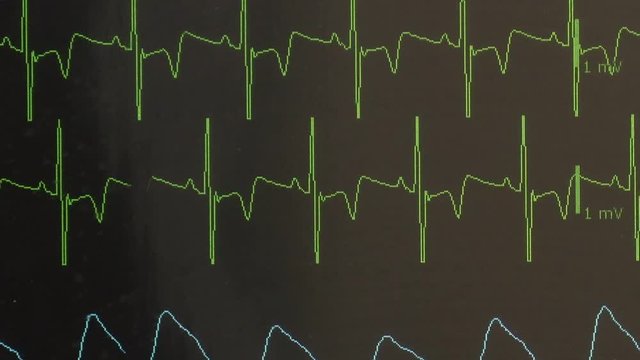 Cardiogram of rhythm of heart and pulse image on monitor during operation. Professional work of surgeon doctor.