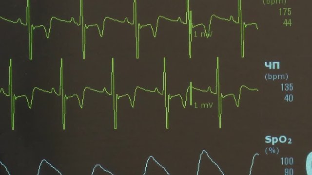 Cardiogram of rhythm of heart and pulse image on monitor during operation. Professional work of surgeon doctor.