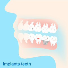 cartoon implants teeth