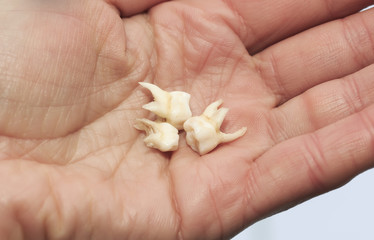 pull the three children's milk tooth are clearly visible