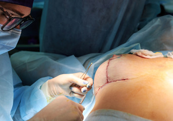 Operation close up. Breast augmentation surger