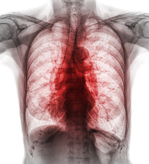 Pulmonary Tuberculosis . Film chest x-ray show interstitial infiltrate both lung due to Mycobacterium tuberculosis infection