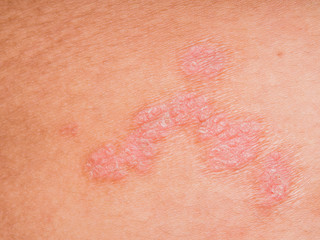Psoriasis skin.