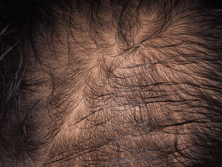 closeup of hair lose