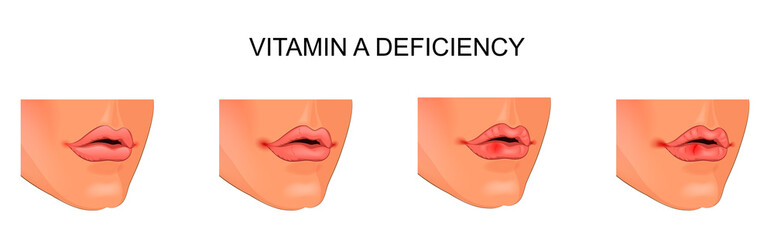 vitamin А deficiency