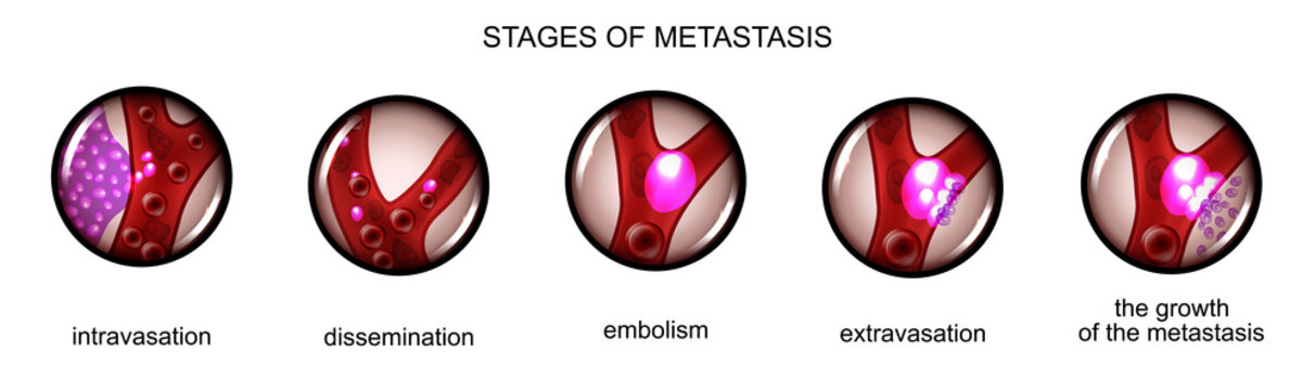 Stage Metastasis Of Cancer Cells