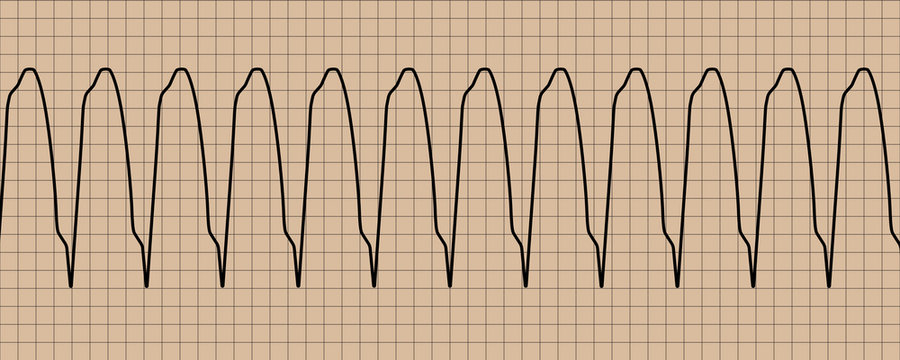 Monomorphic Ventricular Tachycardia Cardiogram
