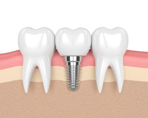 3d render of teeth with dental implant in gums