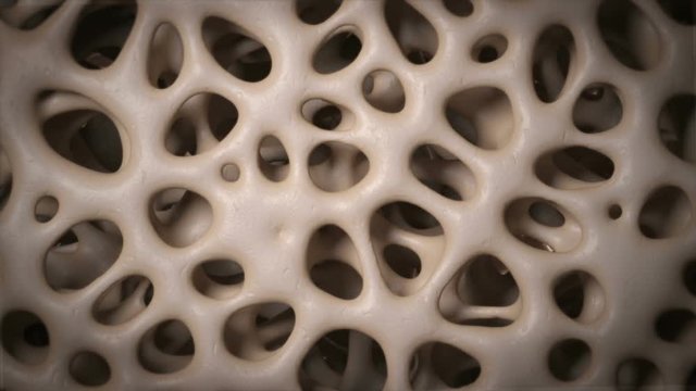 3D CG animation of osteoporosis bone micro structure