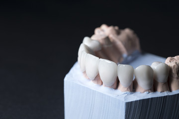 Zircon dentures on a gypsum jaw - side view of Ceramic dentures -