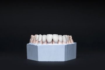 Zircon dentures on a gypsum jaw - side view of Ceramic dentures -