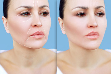 Marking the face.Perforation lines on females face, plastic surgery concept.