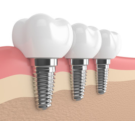 3d render of dental implants in gums