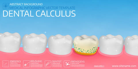 Obraz premium Dental calculus horisontal medical banner template.