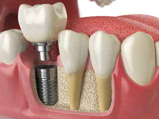 Anatomy of healthy teeth and tooth dental implant in human denturra. - obrazy, fototapety, plakaty