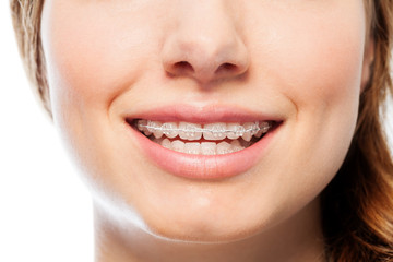 Happy woman's smile with orthodontic clear braces