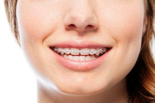 Happy woman's smile with orthodontic clear braces