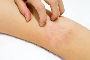 Women's hands are scratching allergy to red rash on white background