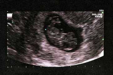 Ultrasound of baby in mother's womb.