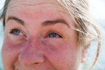 Sonnenbrand im Gesicht