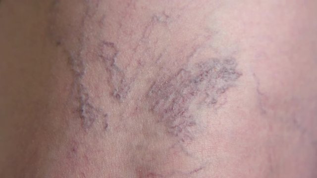 SLOW MOTION MACRO: Purplish hued blue varicose veins on back of knee of a senior woman. Close up view of lady's problematic veins at doctor's office before treatment. Examination of leg blood vessels.