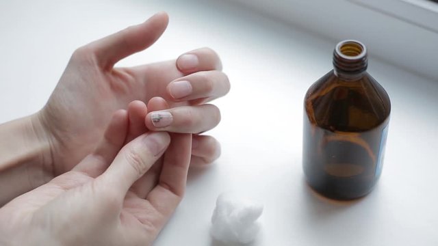 Trauma of toenail. Subungual hematoma. Bruise under the nail of big toe. Injury to the nail. Sick nail. Sickly, diseased, unhealthy nail