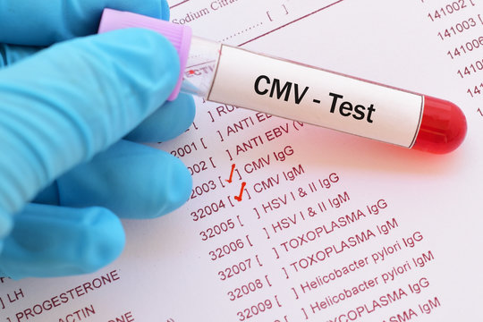 Blood sample with requisition form for cytomegalovirus (CMV) test
