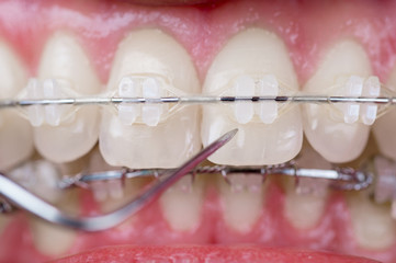 Fototapeta na wymiar Dentist checking up teeth with ceramic brackets using probe at the dental office. Macro shot of teeth with braces. Orthodontic Treatment. Dentistry