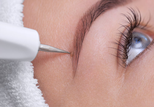 The cosmetologist makes the procedure treatment of Couperose of the facial skin of a beautiful, young woman in a beauty salon.Cosmetology and professional skin care.