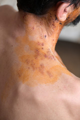 shingles on skin