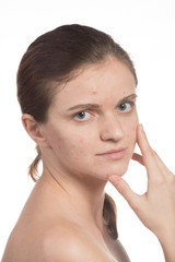 Beautiful girl with red and white acne on her face. Stop acne on a white background.