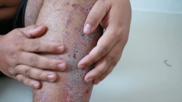 4K Close up shot hands of man scratching skin rash Dermatitis psoriasis patient itchy scratch wound