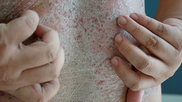 4K Close up shot hands of man scratching skin rash Dermatitis psoriasis patient itchy scratch wound