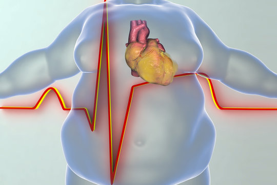 Heart disease in a person with obesity, conceptual image. 3D illustration showing increased weight man with obese heart and ECG of myocardial infarction