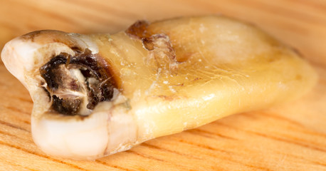 caries in the tooth. macro