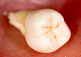 tooth torn. macro