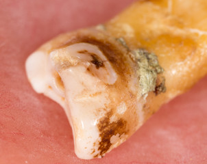 caries in the tooth. macro