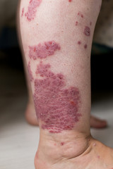 Fototapeta premium One Caucasian woman with psoriasis, eczema, atopic dermatitis on the skin of leg. Skin rashes from contact allergic reaction
