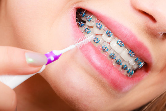 Woman brushing teeth with braces using brush